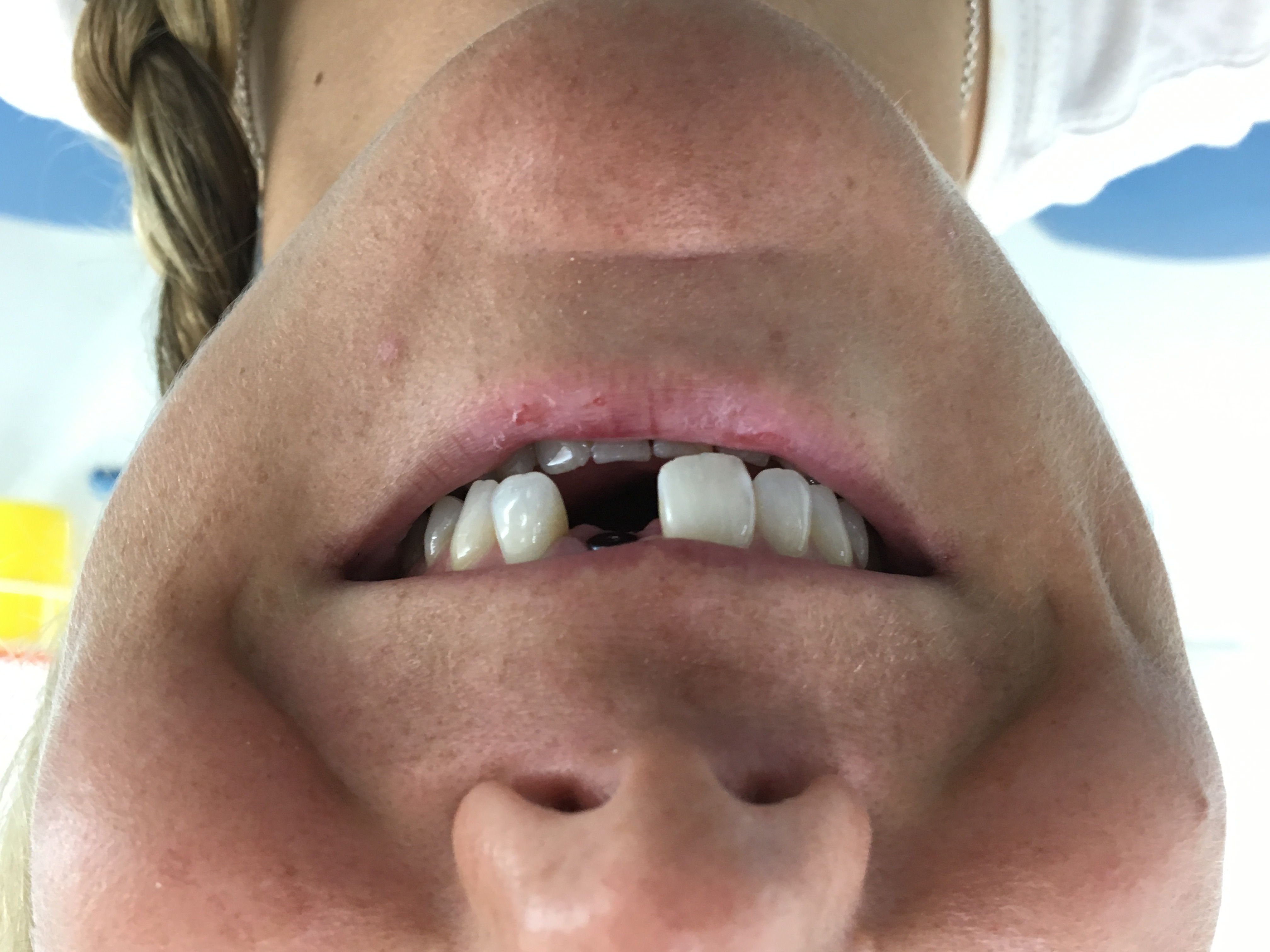Review Implant Bangkok Dental Dentist Clinic By Bangkok Smile Dental 